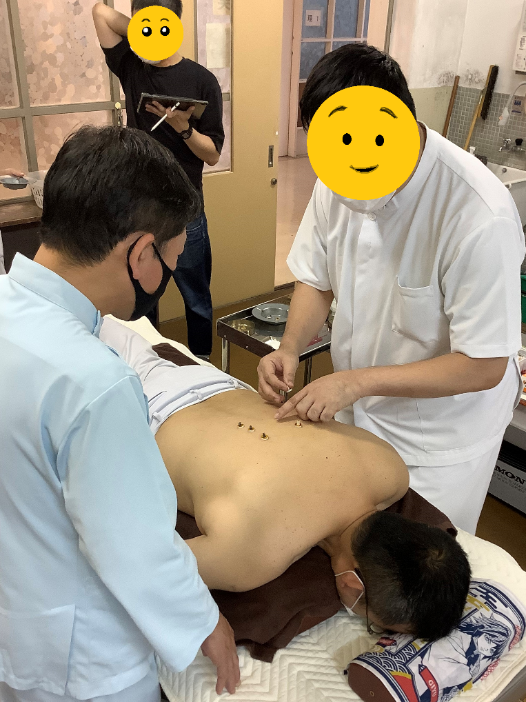 背中のツボに艾を置く